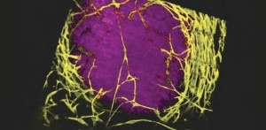 Intravital microscopy of melanoma (purple) and associated blood vessels (yellow).  Photograph courtesy of Erik Sahai, CRUK London Research Institute